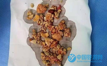 添加輔食不當(dāng)，導(dǎo)致五個(gè)月女嬰患腎結(jié)石，好可憐11