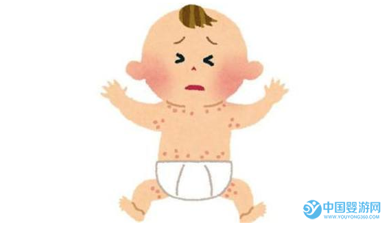 預(yù)防寶寶皮膚過敏，你還可以這樣做 寶寶皮膚過敏癥狀 預(yù)防寶寶皮膚過敏的方法 寶寶皮膚過敏怎么辦3