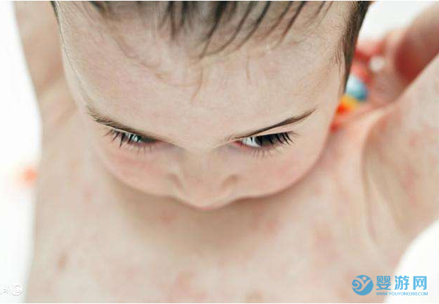 立夏啦，關于寶寶夏季常見的這些皮膚問題你要知道！ 夏季寶寶最容易出現(xiàn)的皮膚問題你要知道！