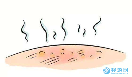 寶寶燙傷怎么辦？ 第一步很關(guān)鍵！千萬別錯過這2分鐘！ 寶寶燙傷的處理方式 如何預(yù)防寶寶燙傷 寶寶燙傷怎么護(hù)理3